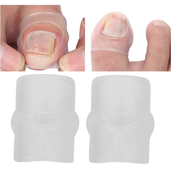 Ingrown Toenail Correction