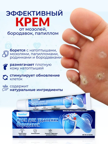 Wart, Callus & Corn Removal Cream: Hands, Feet, Face