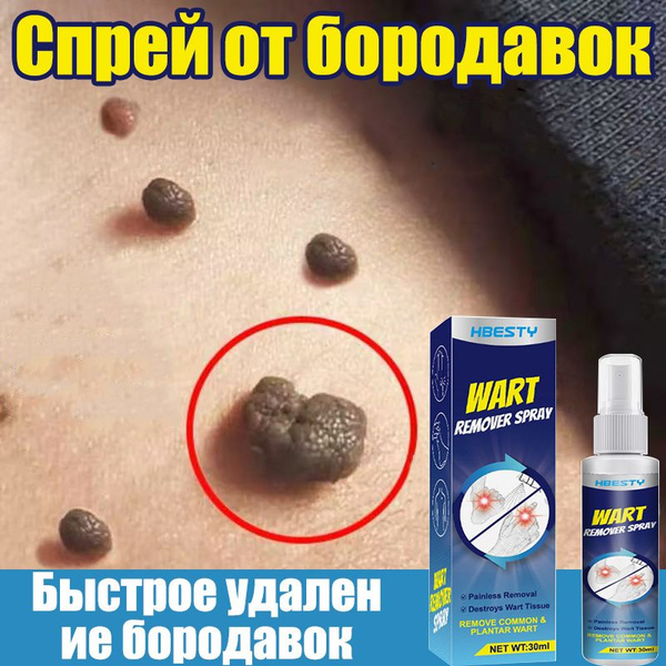 Papilloma & Wart Removal Cream: Body, Hands, Feet, Genital Warts - 30ml