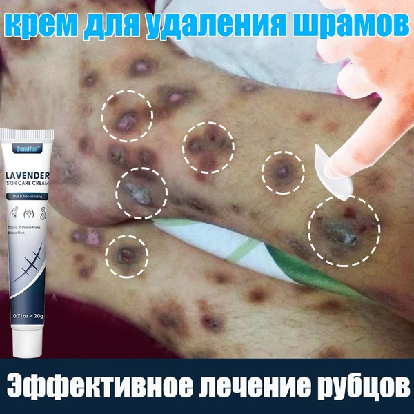 Scar Cream: Effective Treatment for Scars, Stretch Marks, Burns & Acne Scars (20g)