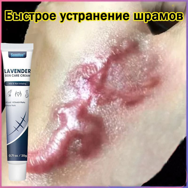 Scar Cream 20g: Fade & Heal Burns & Scars