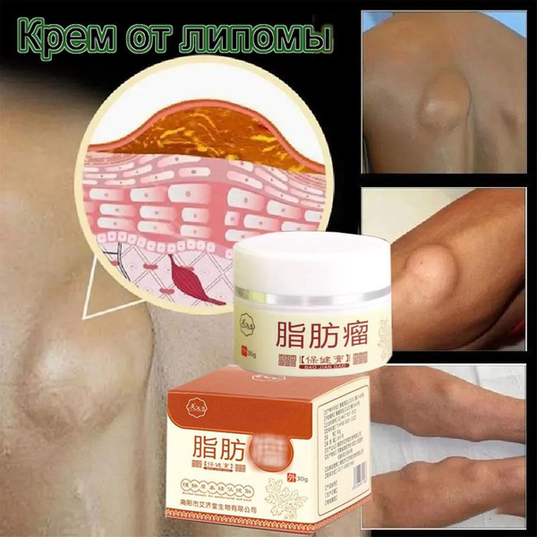 Lipoma Removal Cream: Eliminate Fat Deposits & Subcutaneous Lumps