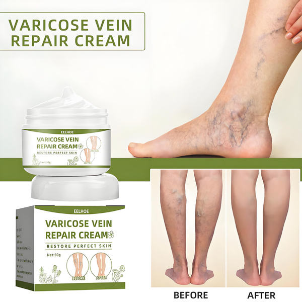 Varicose Vein Cream 50g: Reduce Leg Swelling, Fatigue & Pain