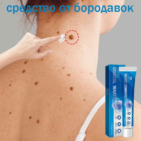 Wart & Papilloma Spray 30ml - Celandine Extract