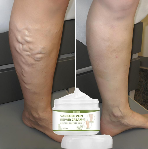 Varicose Veins Ointment: Reduce Swelling, Inflammation & Restore Elasticity (50ml)