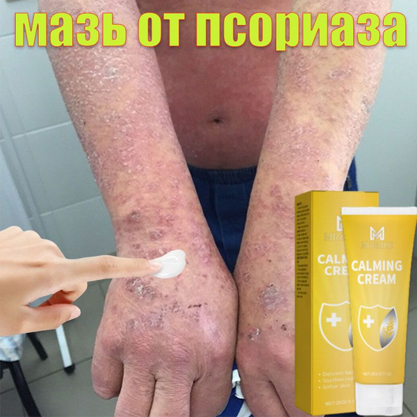 Effective Chinese Ointment for Psoriasis, Ringworm, Eczema, Dermatitis, Herpes, Acne (20g)