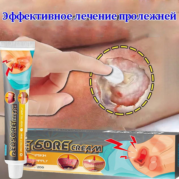 Wound & Pressure Sore Ointment (20g) - Treats Moderate to Heavy Exudate
