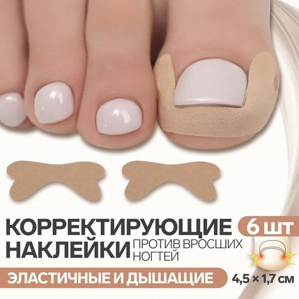 Ingrown Toenail Corrector Kit (6pcs, Beige)