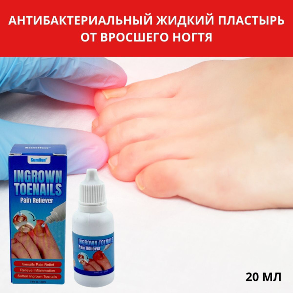 Ingrown Toenail Antibacterial Liquid Bandage