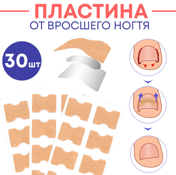Ingrown Toenail Corrector Patches (30 Count)