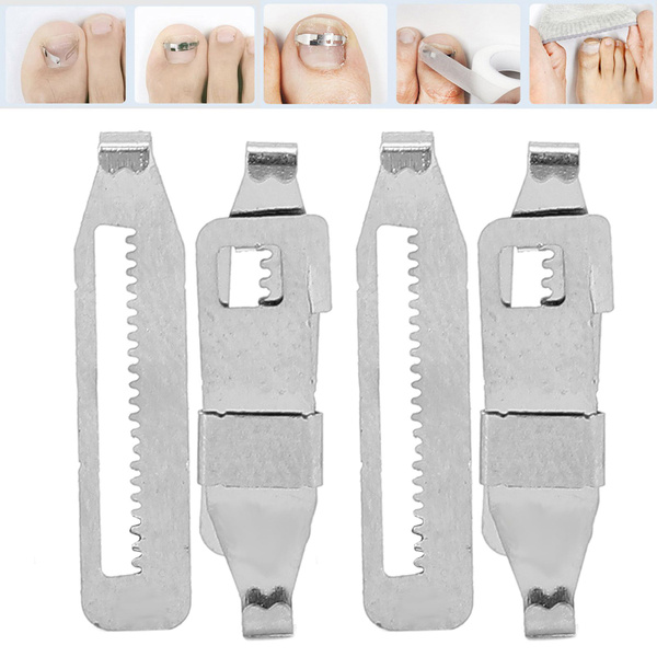 Ingrown Toenail Corrector