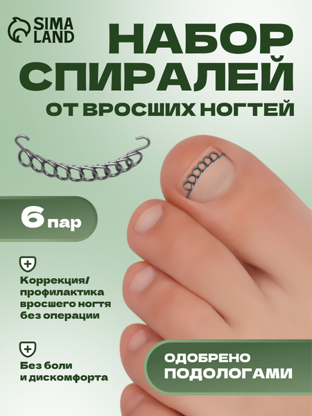 Ingrown Toenail Corrector Spiral Set, 12 Pcs, Silver