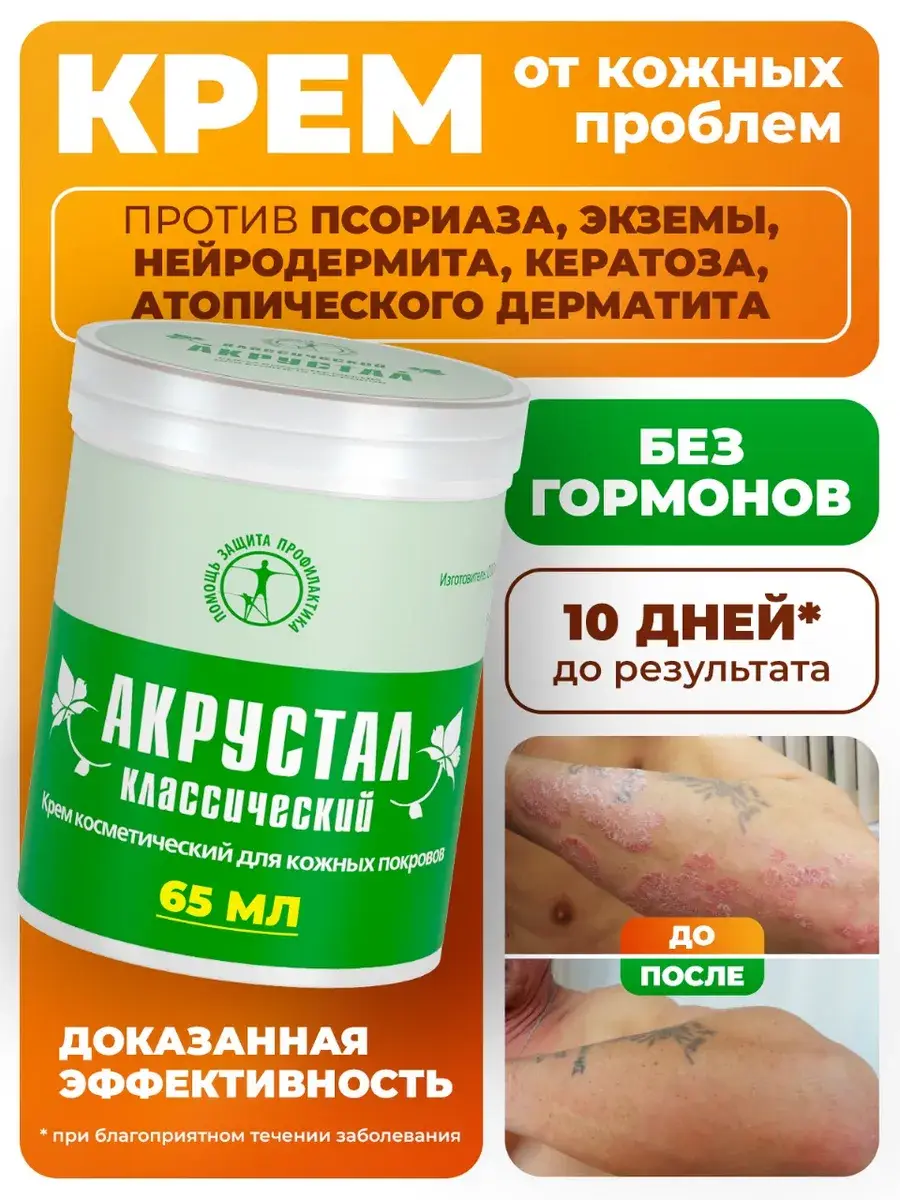 Akrustal Classic Psoriasis and Eczema Cream, 65 ml