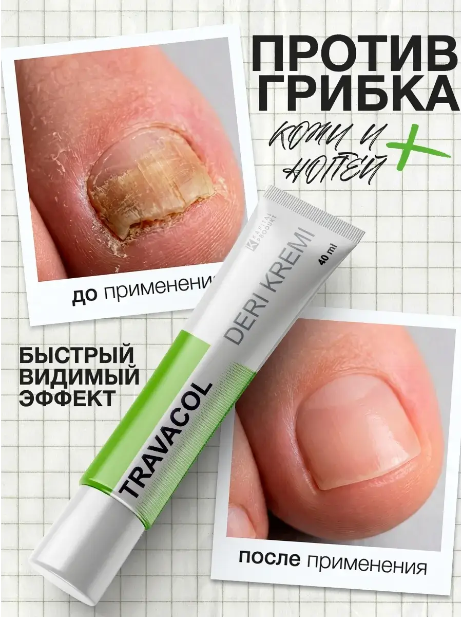 Antifungal Nail Cream 40 ml