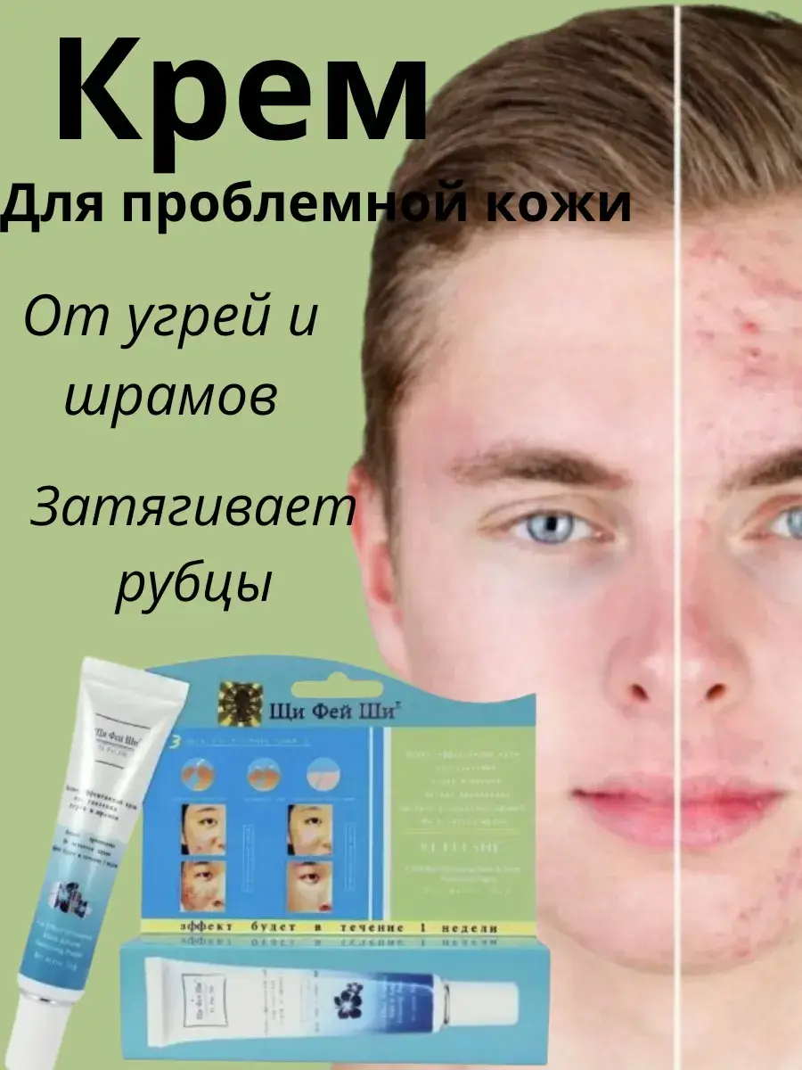 Xi Fei Shi Acne and Scar Facial Cream 35 ml