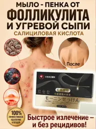 Acne Soap for Face and Body, 80 g #1