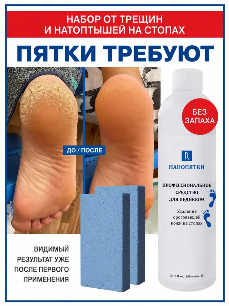 Nanopyatki Foot Keratolytic Solution 300 ml Set #1