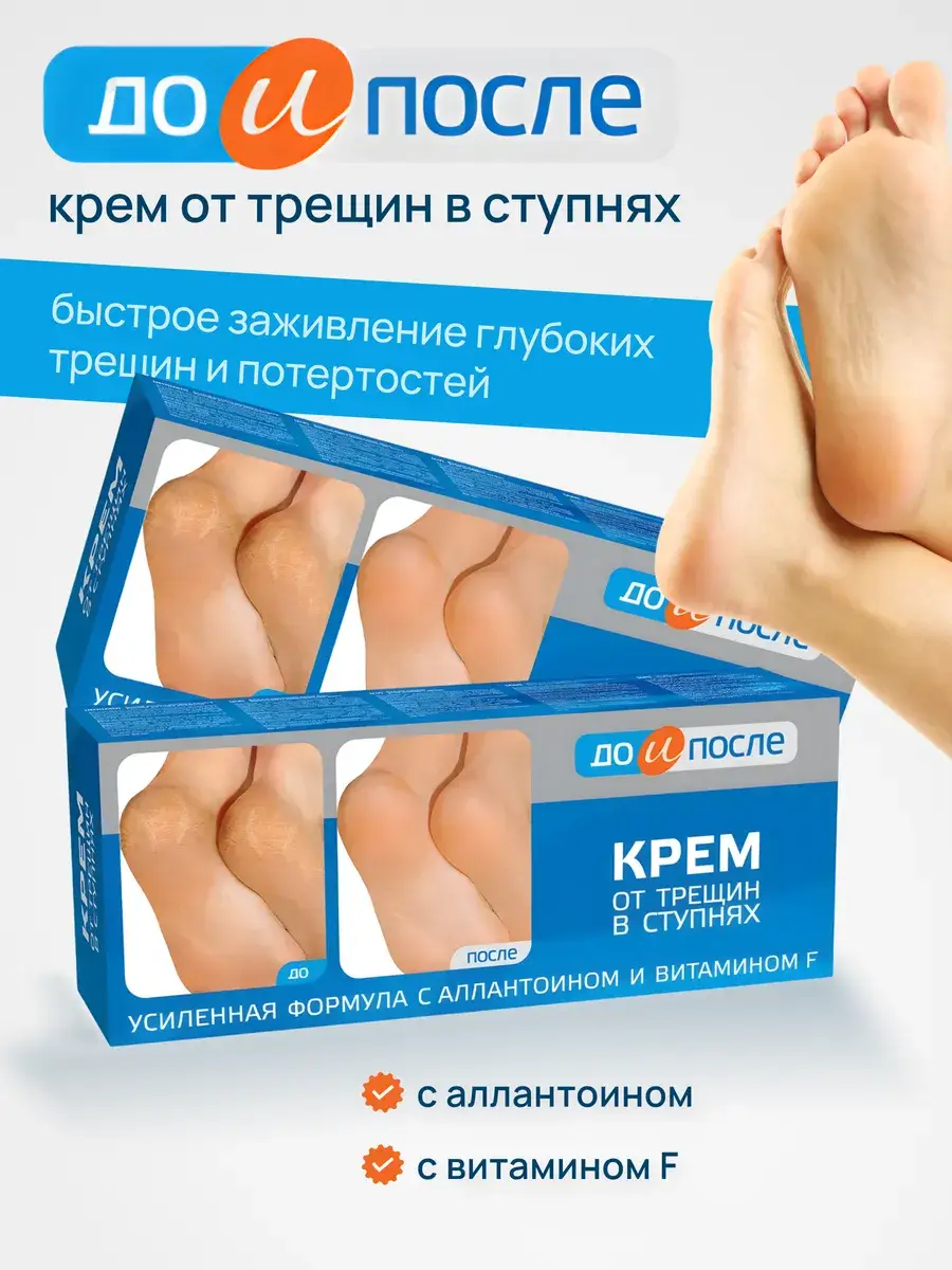 Before and After Foot Cream for Cracks 2 Pack 50 ml, 2 Count