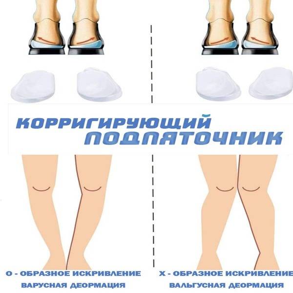 MyBalance Silicone Corrective Orthopedic Insoles — 2 Pack, 11 cm, Universal