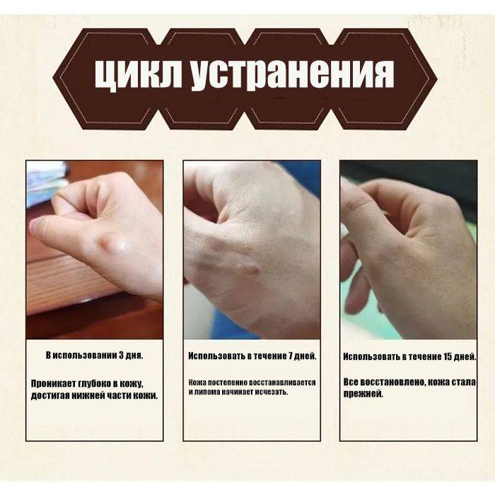 Cream for Subcutaneous Swellings - 20ml, for Skin Edema, Cellulite, and Fibroadipose Tumors #3