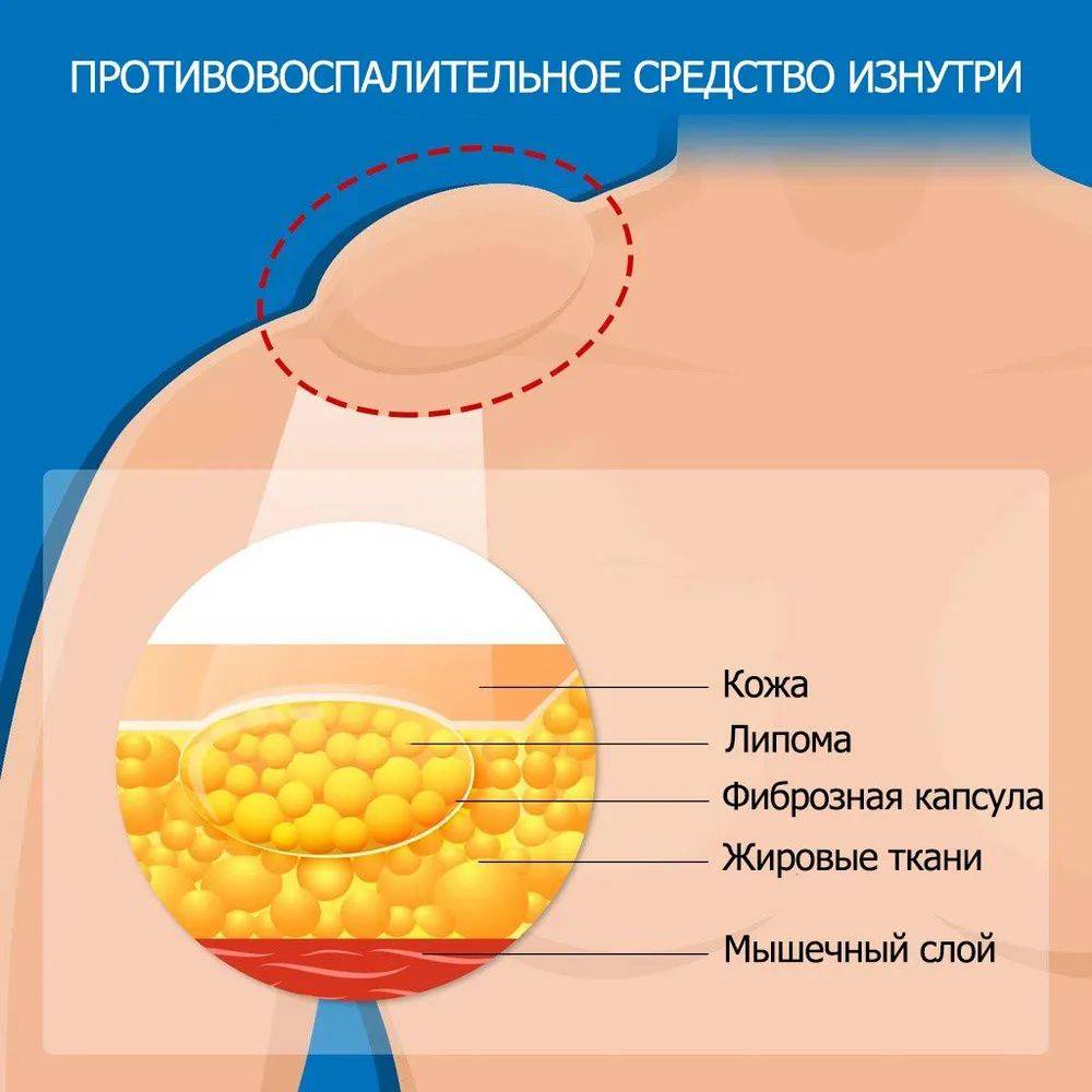 Cream for Subcutaneous Swellings - 20ml, for Skin Edema, Cellulite, and Fibroadipose Tumors #6