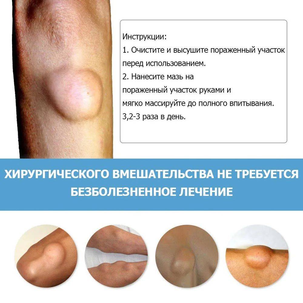 Cream for Subcutaneous Swellings - 20ml, for Skin Edema, Cellulite, and Fibroadipose Tumors #11