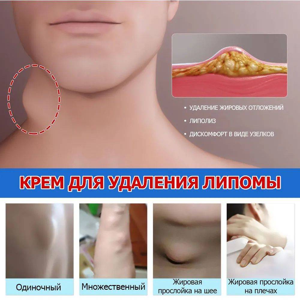 Cream for Subcutaneous Swellings - 20ml, for Skin Edema, Cellulite, and Fibroadipose Tumors #5