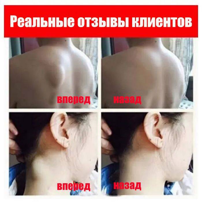 Cream for Subcutaneous Swellings - 20ml, for Skin Edema, Cellulite, and Fibroadipose Tumors #2