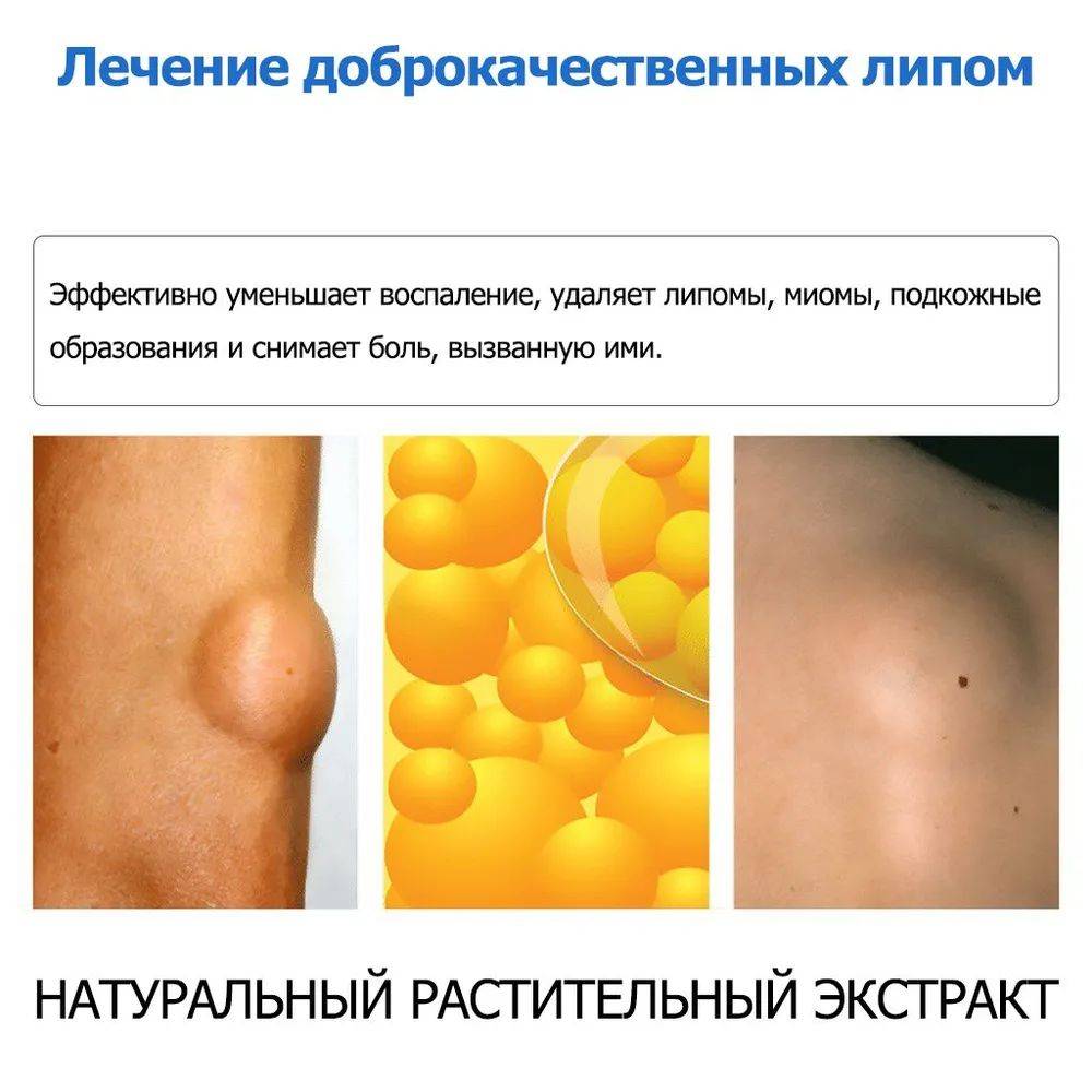Cream for Subcutaneous Swellings - 20ml, for Skin Edema, Cellulite, and Fibroadipose Tumors #7