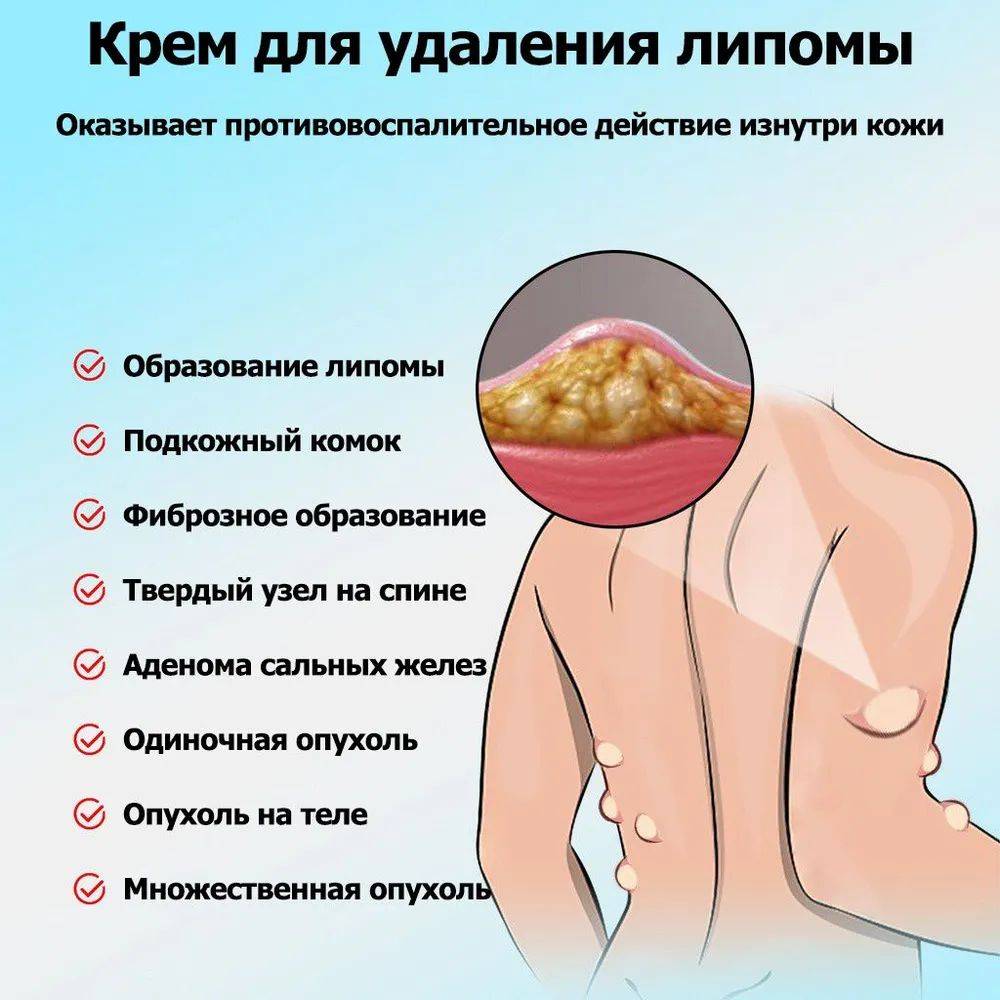 Cream for Subcutaneous Swellings - 20ml, for Skin Edema, Cellulite, and Fibroadipose Tumors #12
