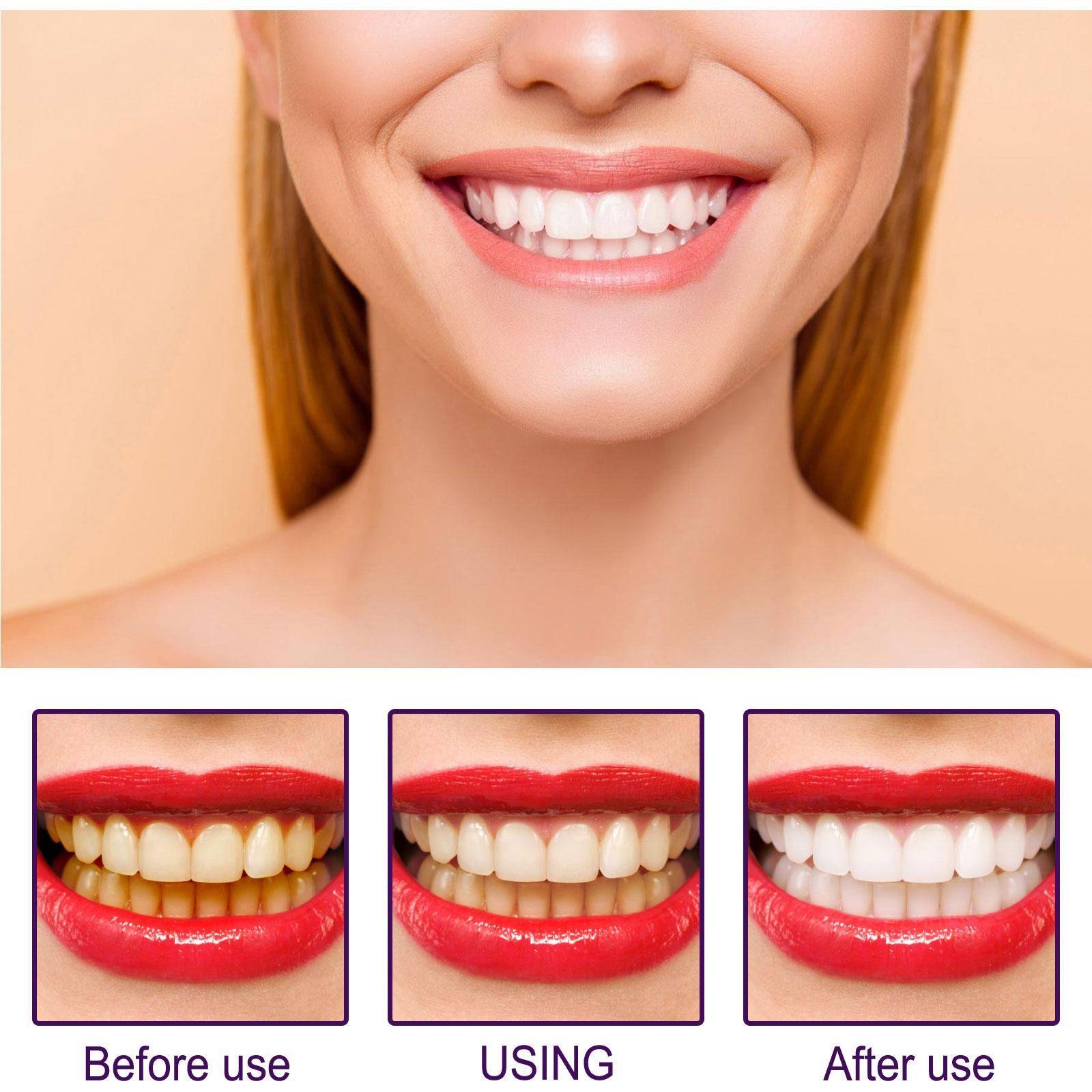 Whitening Pencil for Teeth – Anti‑Pigmentation Gel, 3 ml #9
