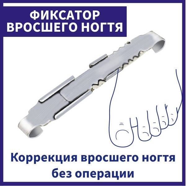 ADL Nail Accessory for Ingrown Toenail, Metal, Gray, 1 Unit