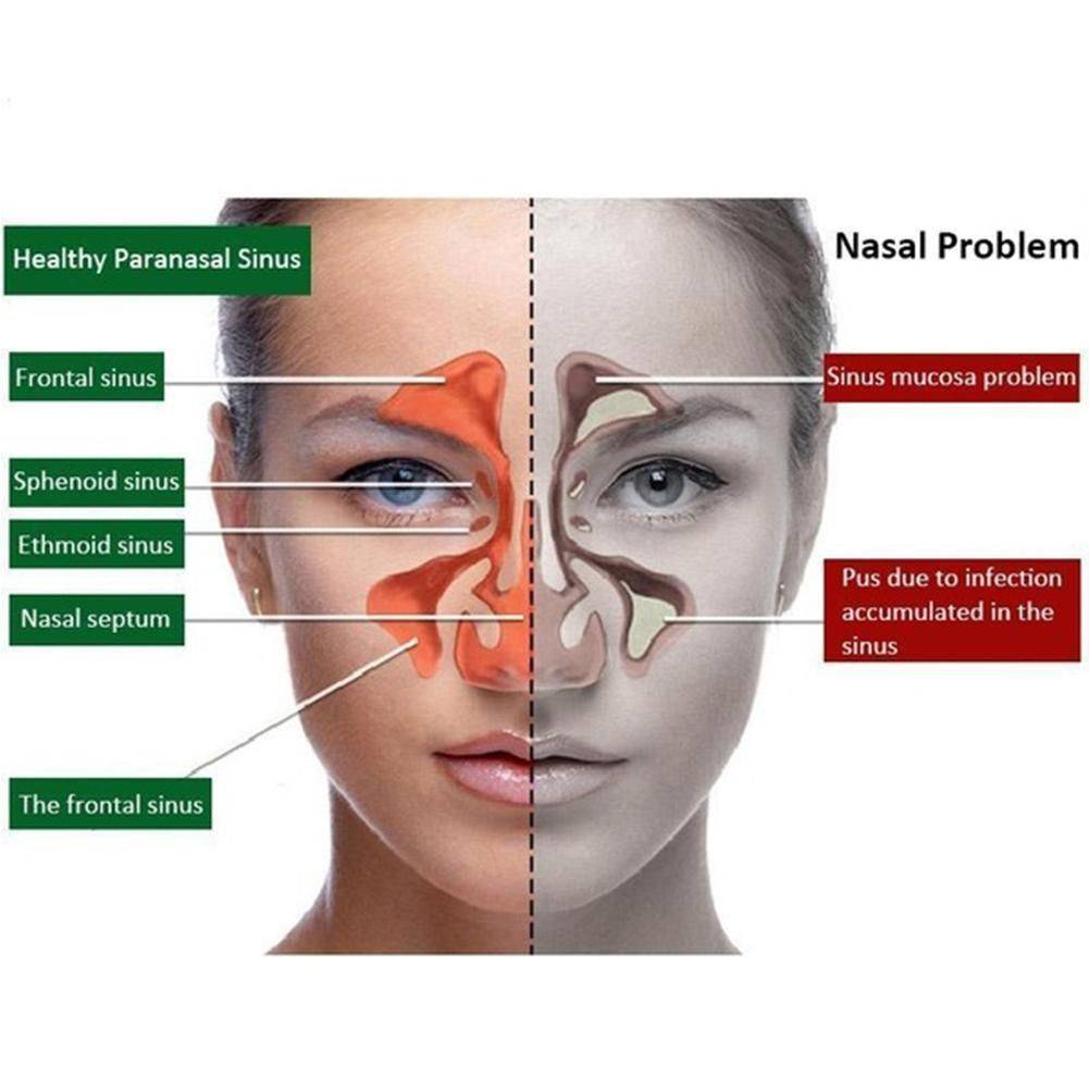 Nasal Spray for Chronic Allergic Congestion and Dry Nasal Itch #11