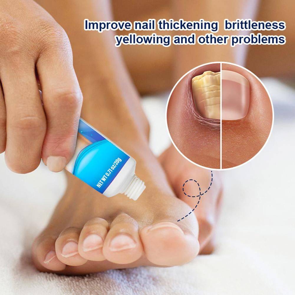 Sumifun Nail Fungus Cream 20 g #10