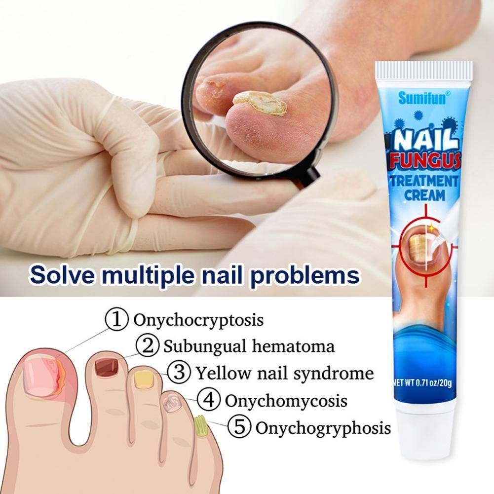 Sumifun Nail Fungus Cream 20 g #12