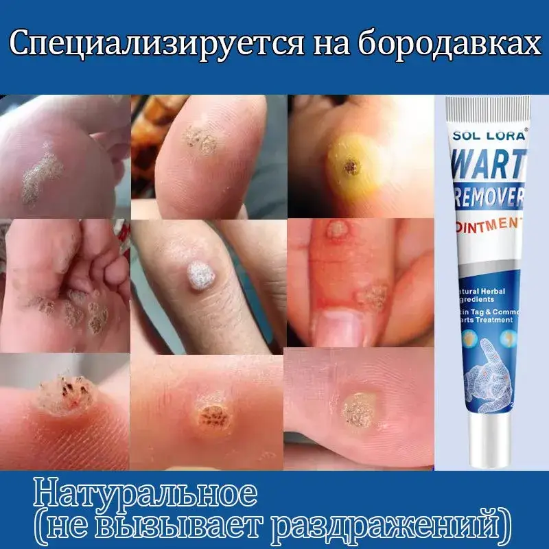 Wart and Papilloma Removal Cream, Corn and Callus Treatment, 20 g