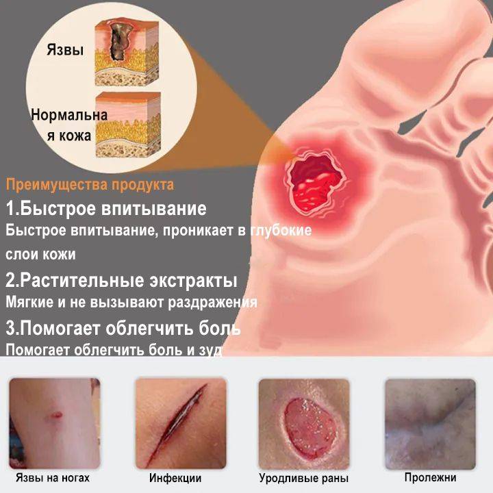 Bed Sore Treatment Cream for Healing Skin Injuries – 20g #7