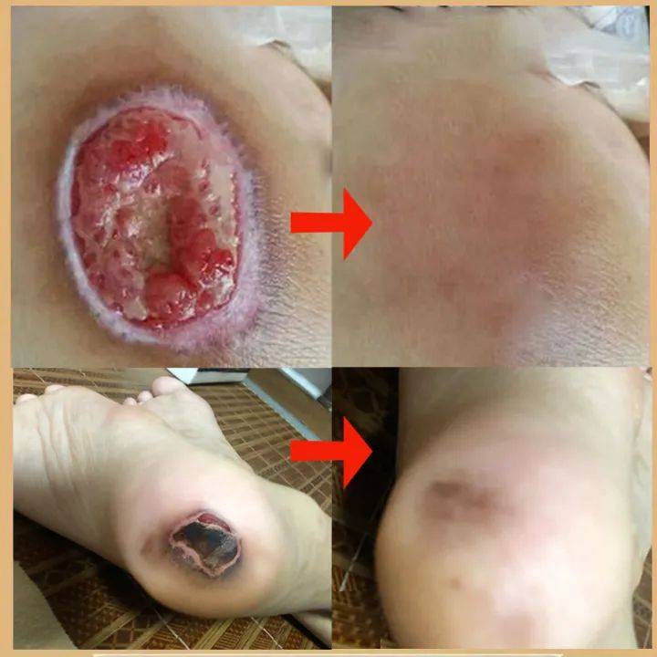 Bed Sore Treatment Cream for Healing Skin Injuries – 20g #5