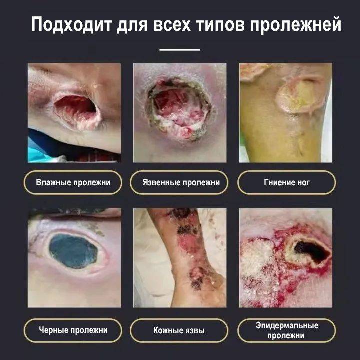 Bed Sore Treatment Cream for Healing Skin Injuries – 20g #2