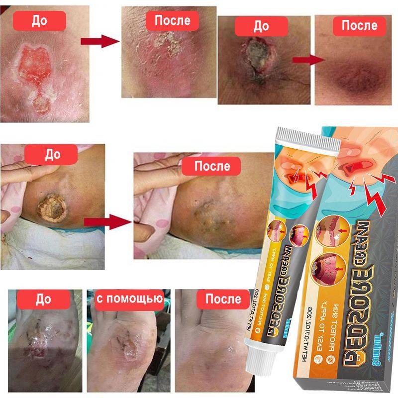 Bed Sore Treatment Cream for Healing Skin Injuries – 20g #6