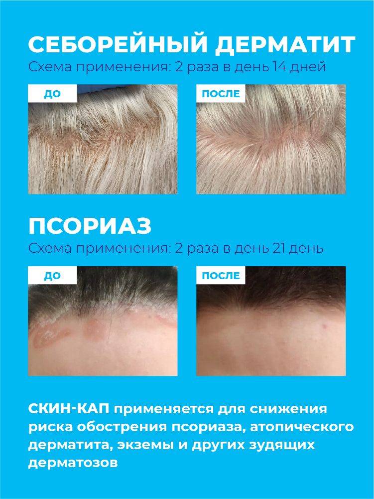 SKIN-CAP Aerosol/Spray with Activated Zinc Pyrithione 70 g 4+4 Pack #4