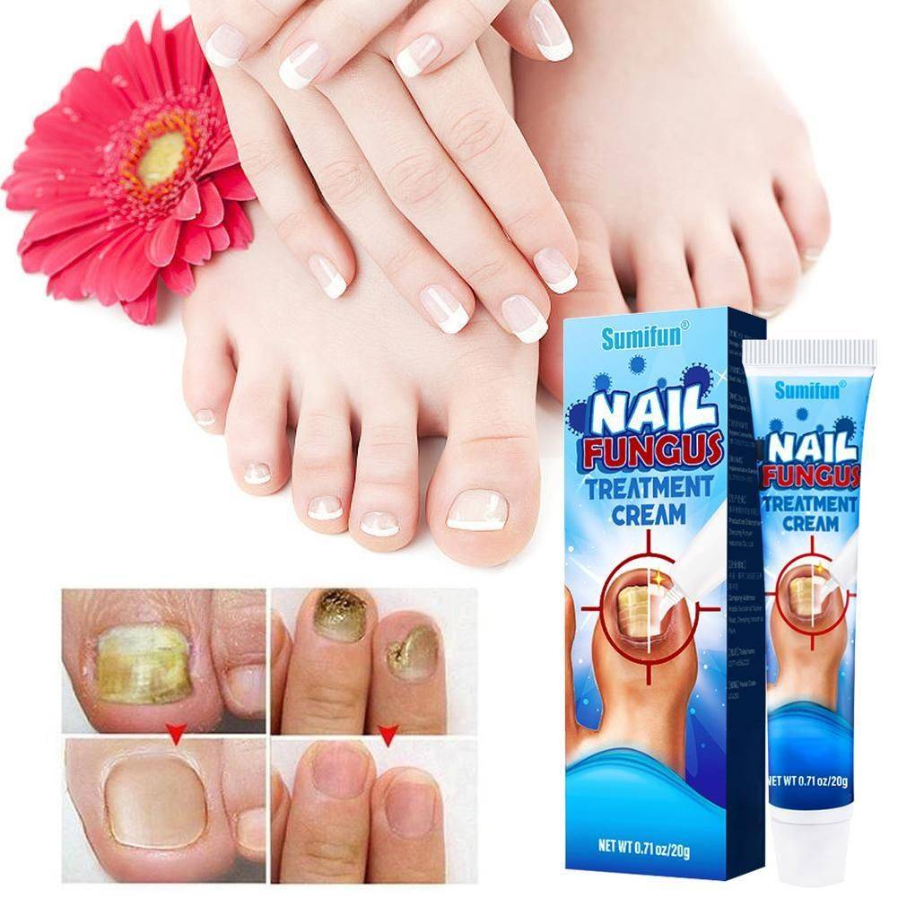 Sumifun Nail Fungus Cream 20 g #3
