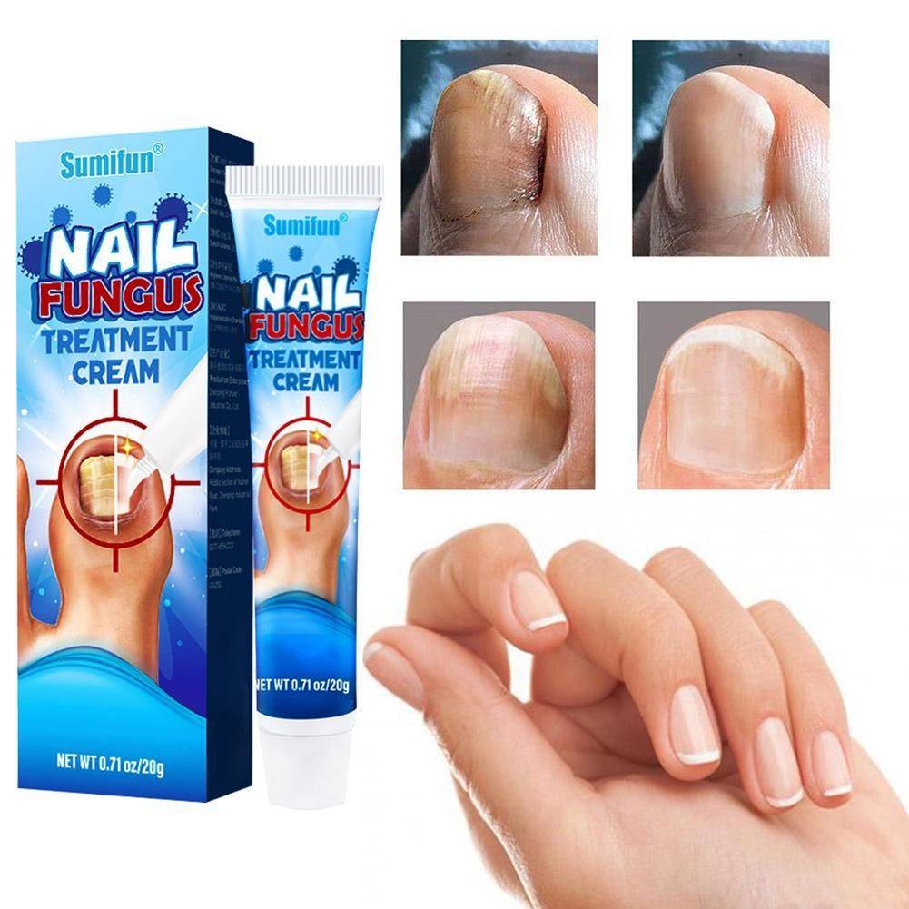 Sumifun Nail Fungus Cream 20 g #2