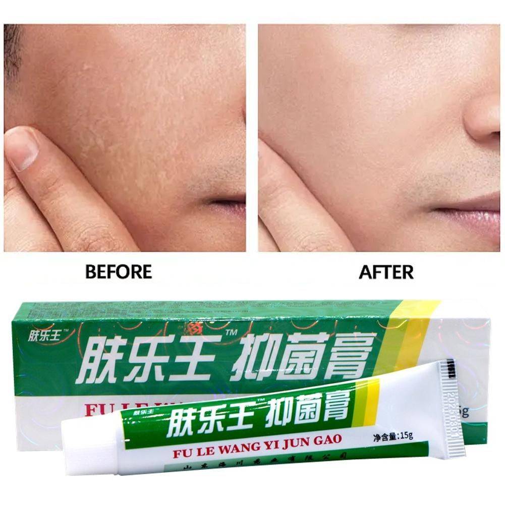 15ml Psoriasis Eczema Dermatitis Cream - Antimicrobial Skin Treatment #10