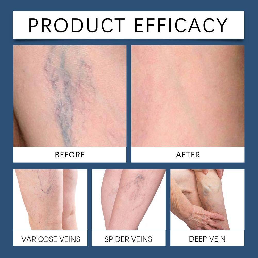 Varicose Vein & Spider Vein Relief Spray, 30ml #13