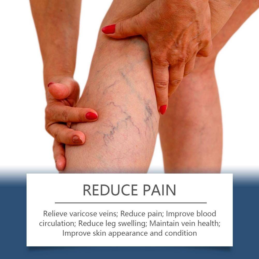 Varicose Vein & Spider Vein Relief Spray, 30ml #9