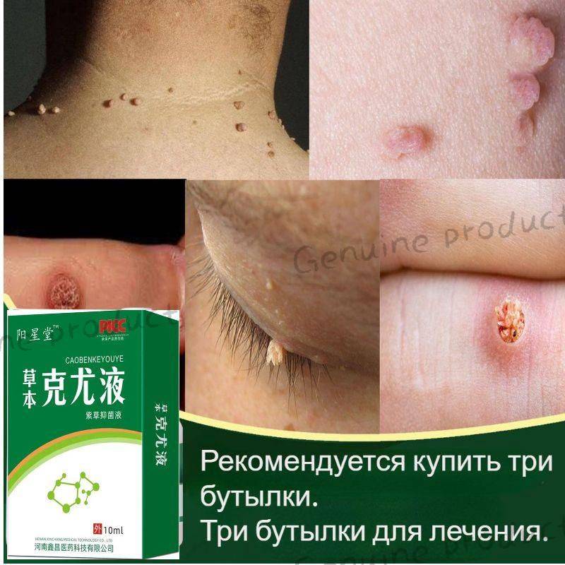 Wart Removal Liquid, 10ml
