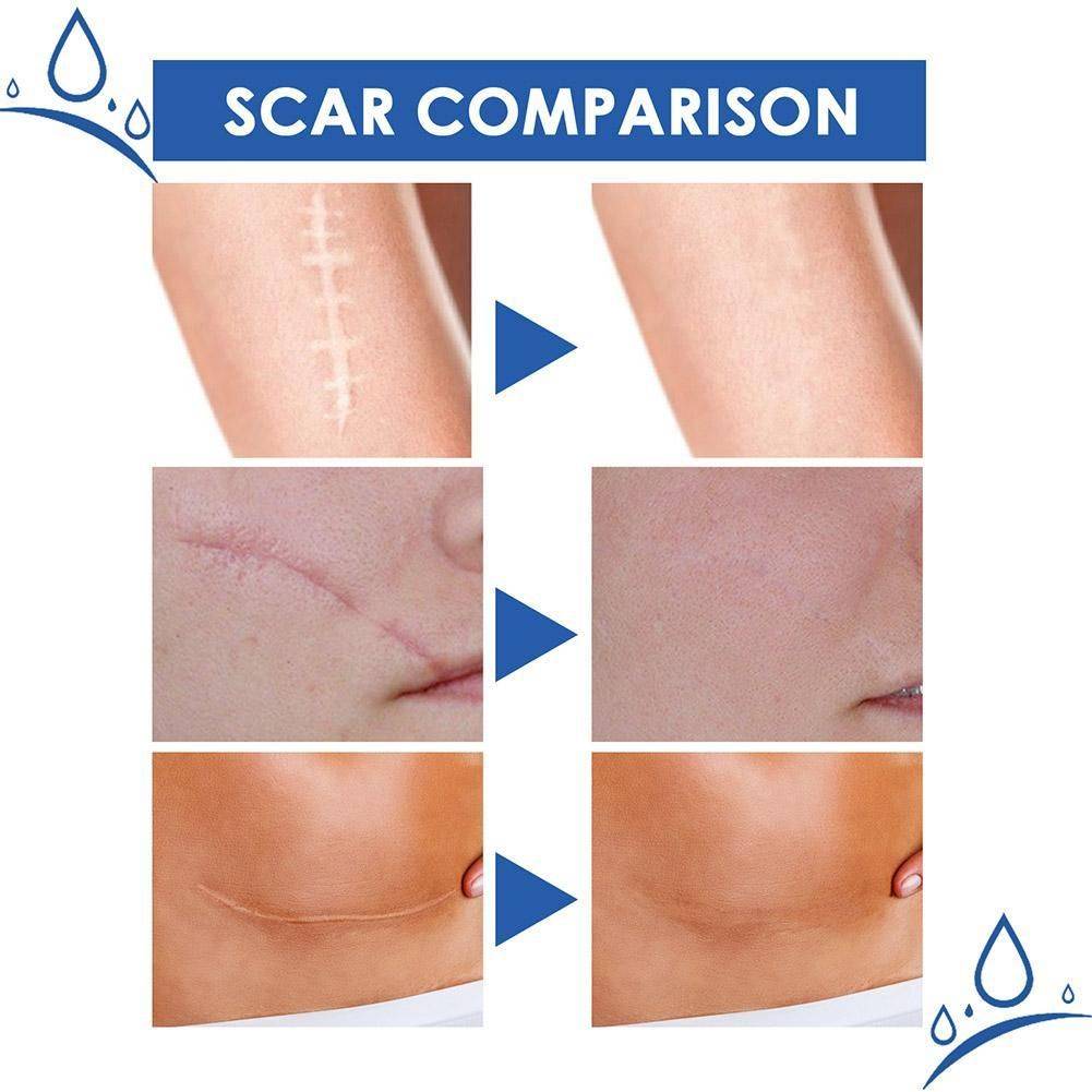 15 g Scar & Stretch Mark Healing Cream – Facial & Body Care #12
