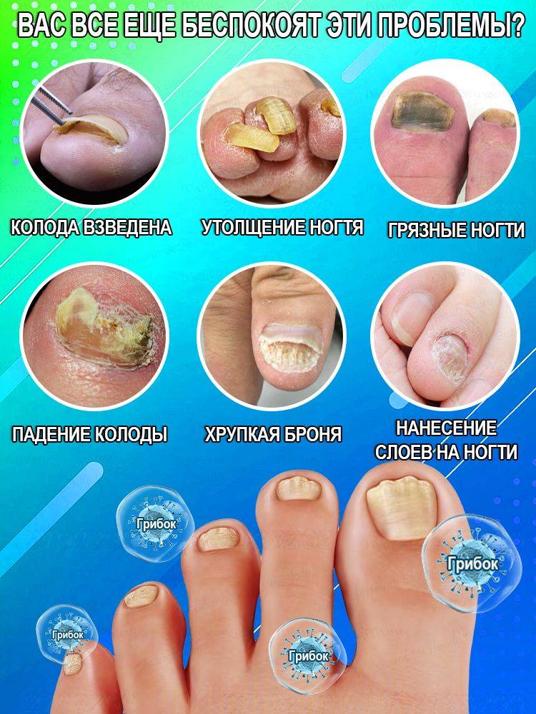 Antifungal Cream for Nail Restoration, Itch Relief, and Health, 20g #4