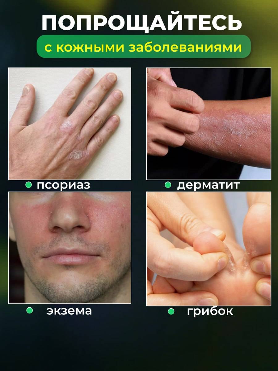 YIGANERJING Zudaifu Cream for Psoriasis, Eczema & Dermatitis – 15g Natural Skin Care #2